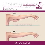 جراحی زیبایی بازو