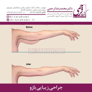 جراحی زیبایی بازو