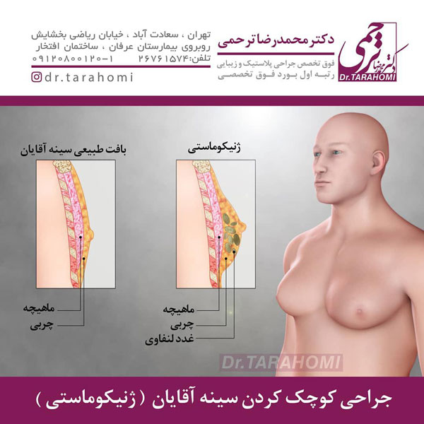 عکس ژنیکوماستی - دکتر ترحمی 