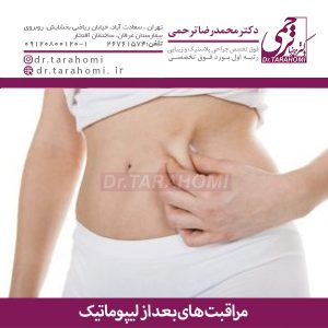 مراقبت های بعد از لیپوماتیک