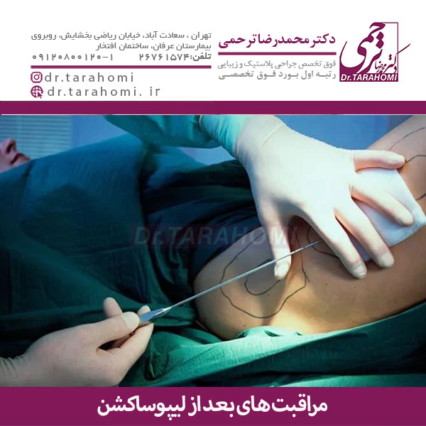 مراقبت های بعد از لیپوساکشن