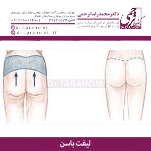 لیفت باسن- دکتر ترحمی