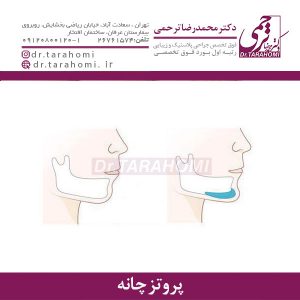 پروتز چانه