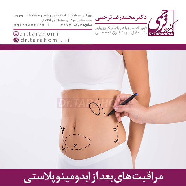 مراقبت های بعد از ابدومینوپلاستی