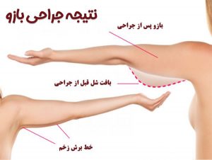 جراحی زیبایی بازو - دکتر ترحمی