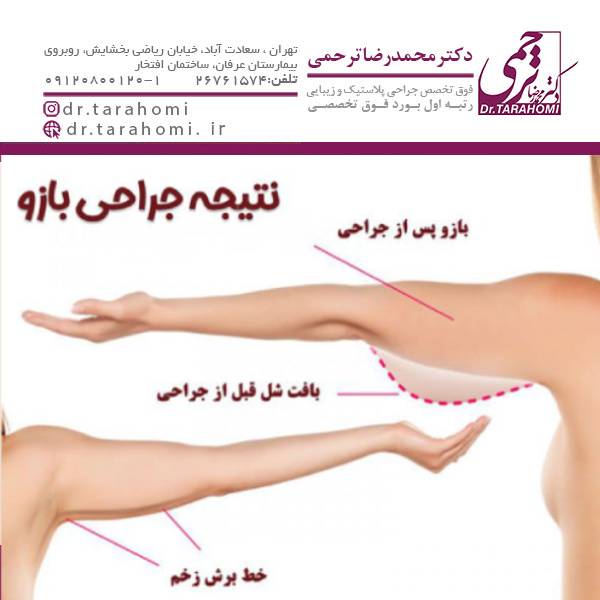 عکس نتیجه جراحی بازو