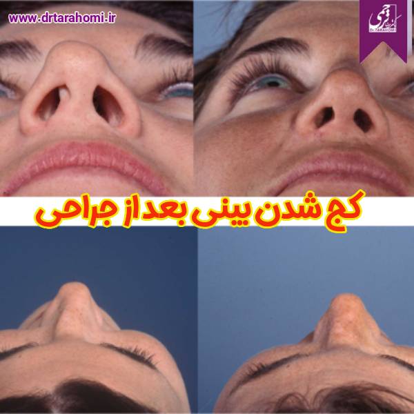 کج شدن بینی بعد از جراحی - دکتر محمدرضا ترحمی