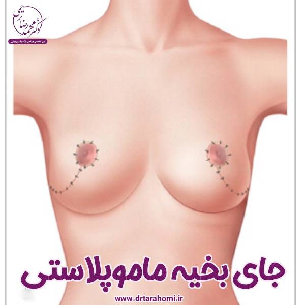 جای بخیه ماموپلاستی - دکتر محمدرضا ترحمی