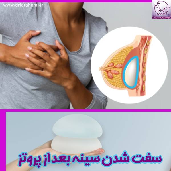 سفت شدن سینه بعد پروتز - دکتر محمدرضا ترحمی