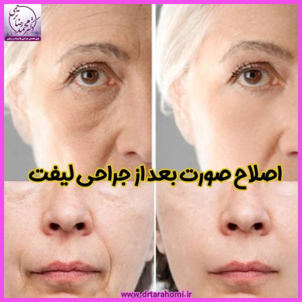 اصلاح صورت بعد از جراحی لیفت - دکتر محمدرضا ترحمی