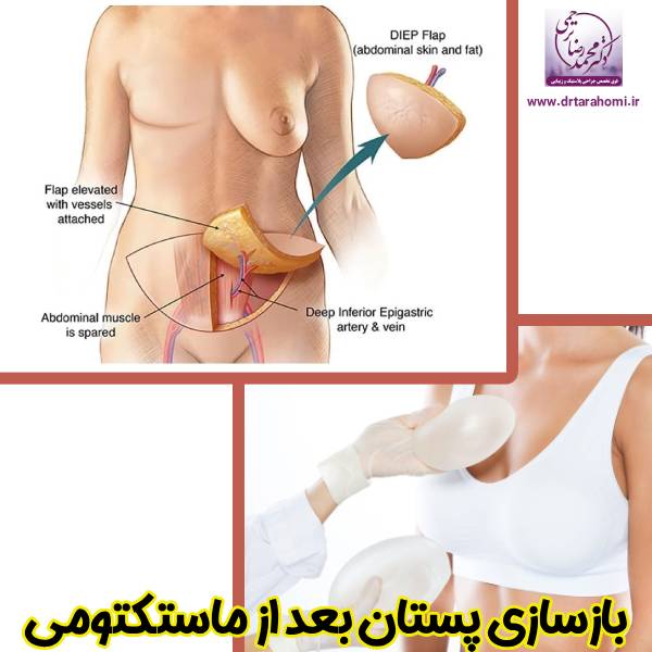 بازسازی پستان بعد ماستکتومی - دکتر محمدرضا ترحمی