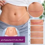 اسکار بعد از ابدومینوپلاستی