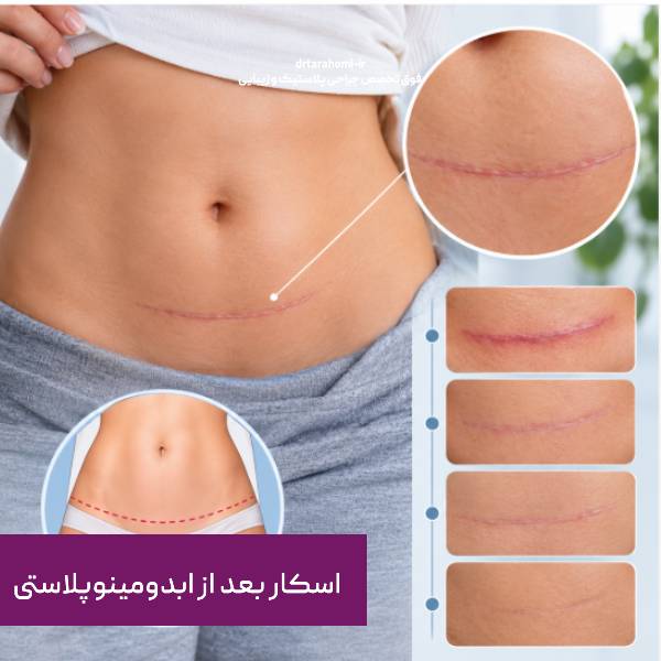 اسکار بعد از ابدومینوپلاستی