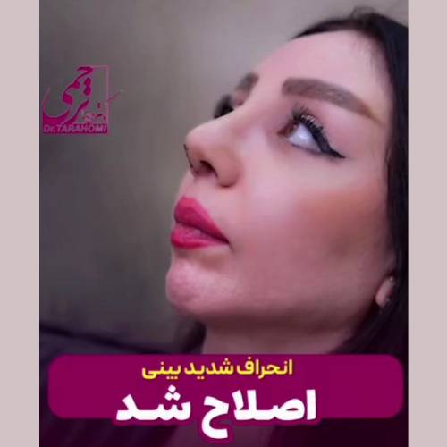 جراحی-بینی-11